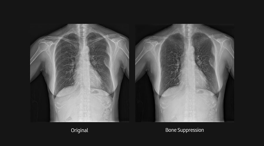 bone-suppression